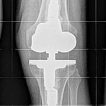 Behandlung von Arthrose des Kniegelenks durch achsführenden Gelenkersatz