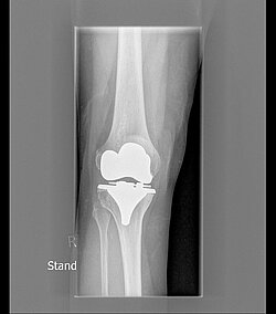 Orthopädie MHK Bergheim_Lockeres Implantat im Knie