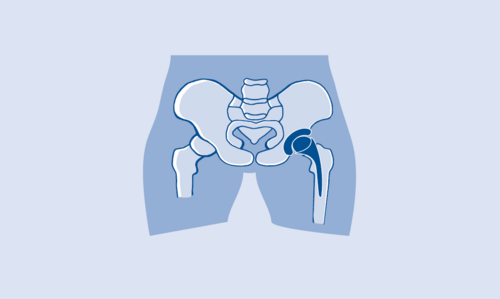 Blaue Zeichnung einer Hüfte mit Prothese
