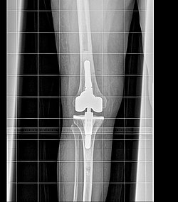 Orthopädie MHK_Wechsel einer lockeren Knieprothese