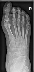 Röntgenbild eines rechten Fußes mit Krallenzehen