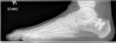 Röntgenbild eines rechten Fußes nach einer Operation