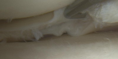 Intraoperative Aufnahme eines gerissenen Meniskus