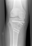 Röntgenbild eines Beines im Kniebereich