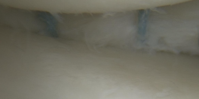 Intraoperative Aufnahme einer Meniskusnaht