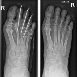Röntgenbild eines operierten rechten Fußes, mit und ohne Drähte