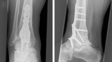 Röntgenbilder eines rechten Sprunggelenks, dass mit Schrauben und Platten versteift wurde