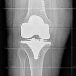 Behandlung der Arthrose des Kniegelenks durch ungekoppelten Oberflächenersatz