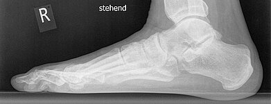 Röntgenbild eines rechten Plattfußes