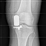 Behandlung von Arthrose des Kniegelenks durch Teilgelenkersatz