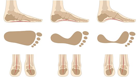 Grafik der Anatomie eines Plattfußes, eines normalen, gesunden Fußes und eines Hohlfußes